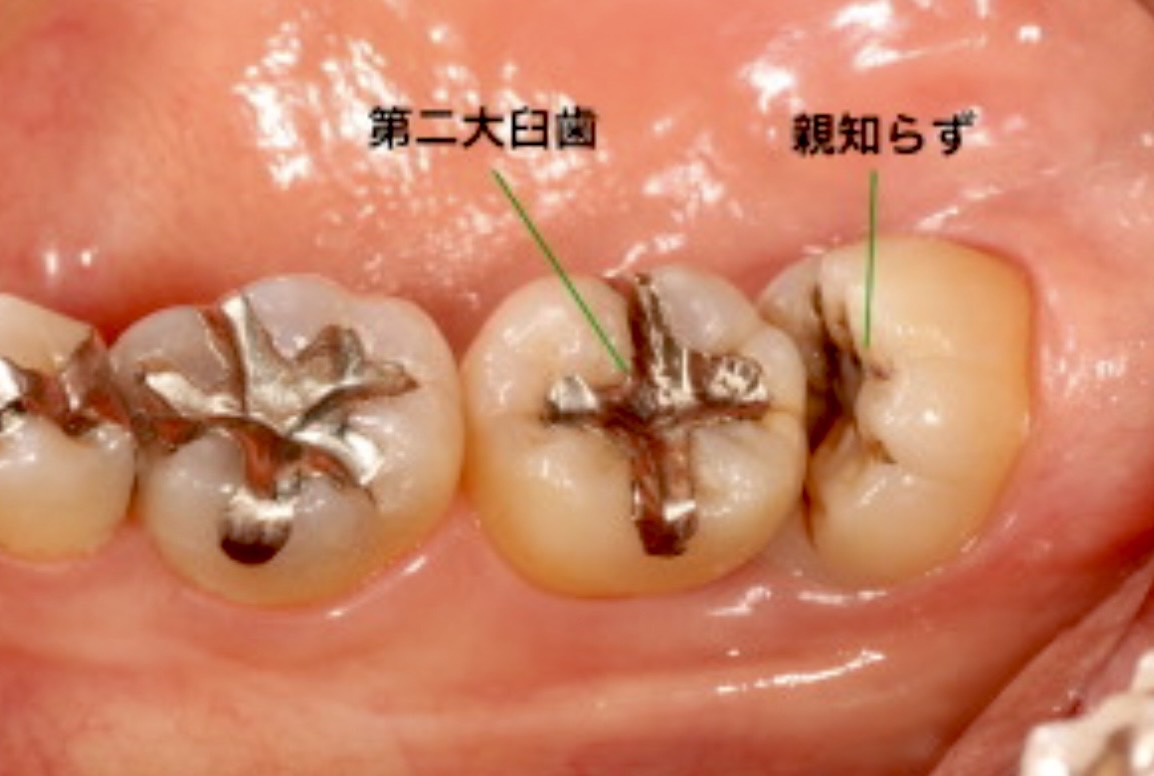 佐賀市の歯医者の親知らずの抜歯