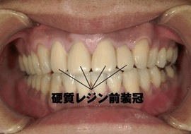 佐賀市の歯医者、佐賀ん歯科・こども歯科でむし歯治療