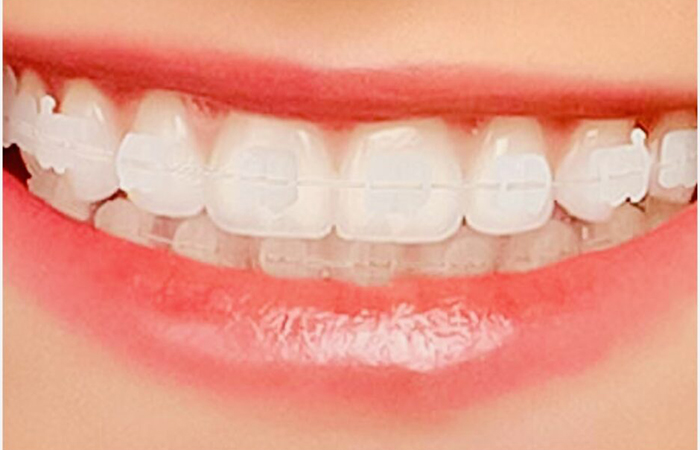 佐賀市の歯医者、佐賀ん歯科・こども歯科で矯正歯科