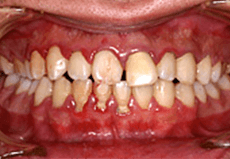 佐賀市の歯医者、佐賀ん歯科・こども歯科で歯周病治療