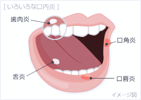 佐賀市の歯医者、佐賀ん歯科・こども歯科で口内炎治療