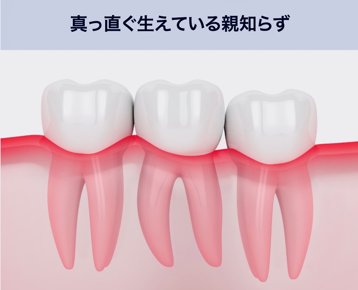 佐賀市の歯医者、佐賀ん歯科・こども歯科で親知らずの抜歯