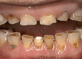 佐賀市の歯医者、佐賀ん歯科・こども歯科で歯ぎしりの治療