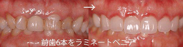 佐賀市の歯医者、佐賀ん歯科・こども歯科でむし歯治療