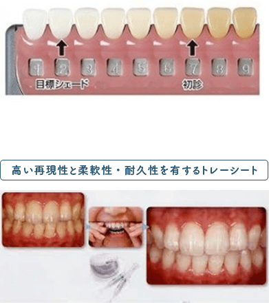 佐賀市の歯医者、佐賀ん歯科・こども歯科で審美歯科