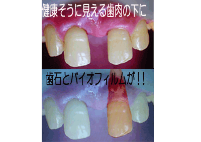 佐賀市の歯医者、佐賀ん歯科・こども歯科の口臭専門外来