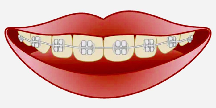 佐賀市の歯医者、佐賀ん歯科・こども歯科で矯正歯科