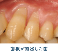 佐賀市の歯医者、佐賀ん歯科・こども歯科で歯周病治療