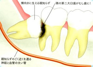 佐賀市の歯医者、佐賀ん歯科・こども歯科で親知らずの抜歯